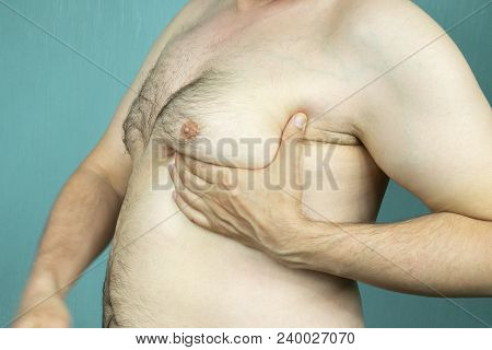 Fat White Middle-aged Man With Gynecomastia, Enlarged Breast