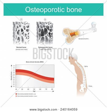Osteoporotic Bone
