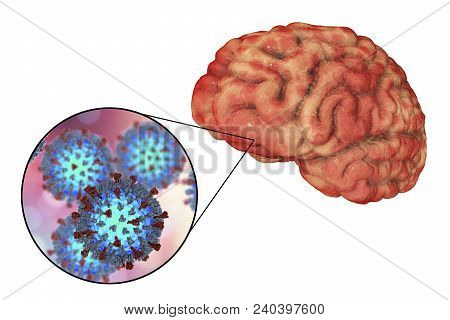 Measles-induced Encephalitis, Medical Concept, 3d Illustration Showing Brain Infection And Close-up 