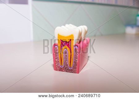 Tooth Model Without Caries, Tooth Decay In Dentist's Office. Healthy Teeth Concept . Children's Dent