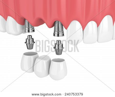 3D Render Of Implants With Dental Bridge In Upper Jaw