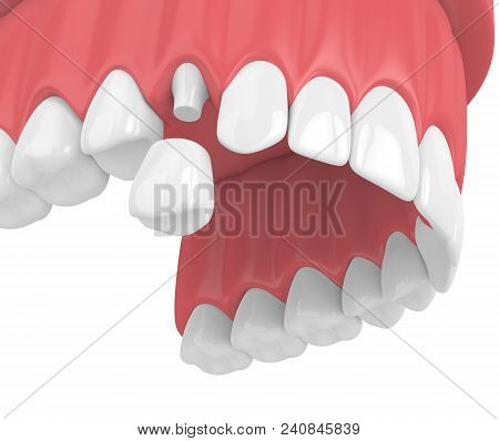 3D Render Of Upper Jaw With Teeth And Dental Premolar Crown