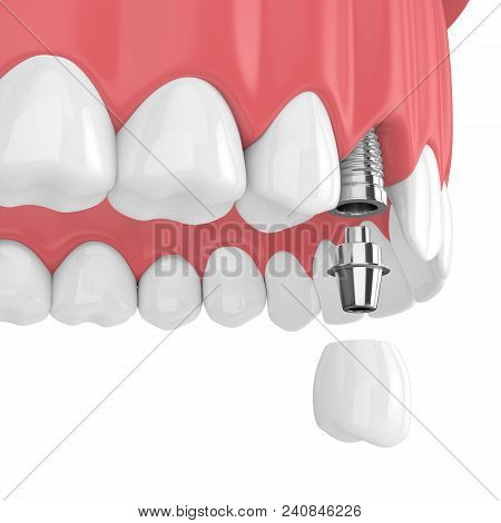 3D Render Of Upper Jaw With Teeth And Dental Premolar Implant