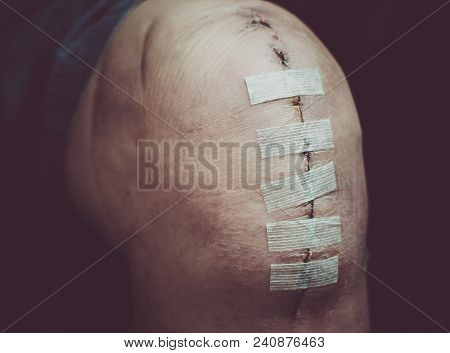 Replacement Knee Surgery Operation On Senior Or Elderly Old Man Patient After Knee Surgery One Week 