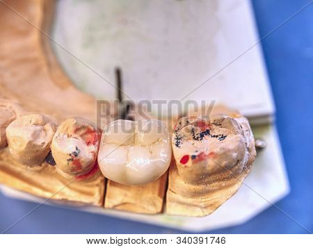Jaw Plaster Cast With Fixed Dentures In Dental Prothetic Laboratory, Technical Shots On