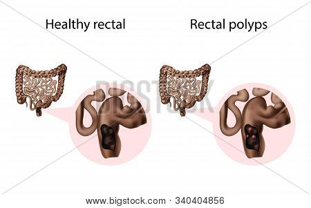 Rectal Polyps Healthy Image & Photo (Free Trial) | Bigstock