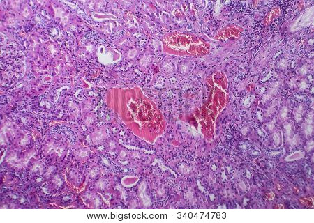 Histopathology Of Hypertensive Renal Disease, Light Micrograph, Photo Under Microscope