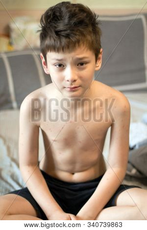 Poor boy with chickenpox. Sad little boy itching the body. Chickenpox rash