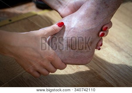 Closeup Feet Of Old Man Suffering From Leprosy With A Cane On The Ground