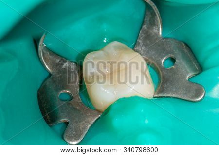 Restoration Of Tooth With Photopolymer Filling Close-up Macro. Caries