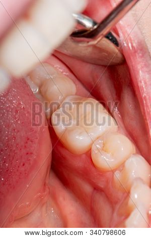 Restoration Of Tooth With Photopolymer Filling Close-up Macro. Caries