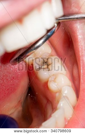Restoration Of Tooth With Photopolymer Filling Close-up Macro. Caries