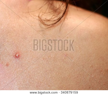 Inflamed Skin On The Face. Acne. Pimples On The Skin. Scars And Peeling.