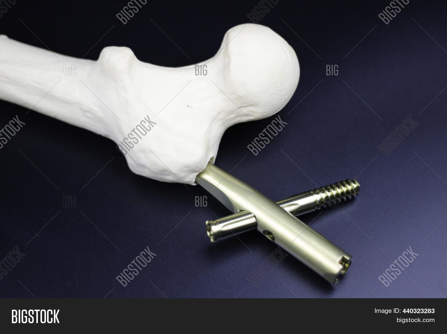 Surgical Plates Image & Photo (Free Trial) Bigstock