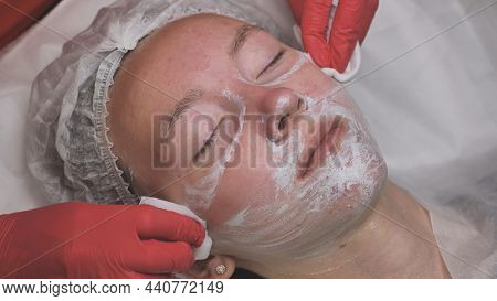 Wipe The Mask Off The Face Of A Girl With Problematic Koja With Cotton Pads.