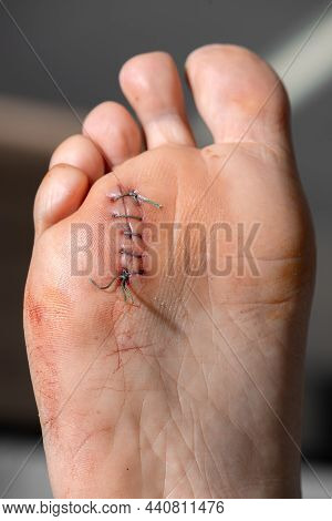 Surgical Cutaneous Suture With Thread After Neurectomy Surgical Removal Of All Or Part Of A Nerve