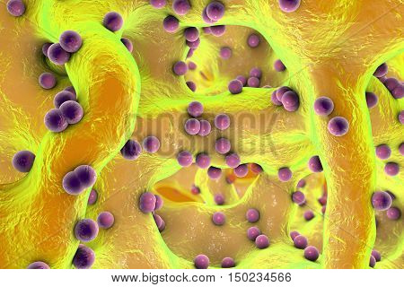 Spherical bacteria inside bone tissue. Osteomyelitis, 3D illustration