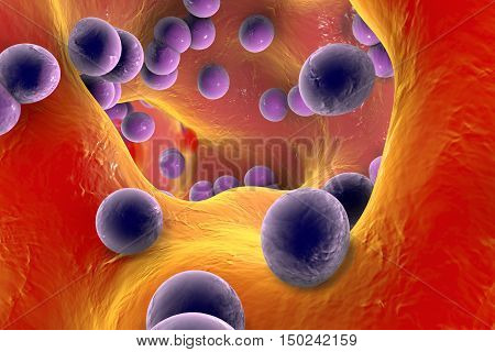 Spherical bacteria inside bone tissue. Osteomyelitis, 3D illustration