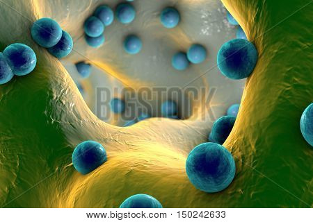Spherical bacteria inside bone tissue. Osteomyelitis, 3D illustration