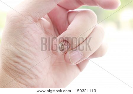 Fungal Nail Infection And Damage On Human Hand. Finger With Onychomycosis