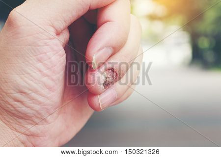Fungal Nail Infection And Damage On Human Hand. Finger With Onychomycosis