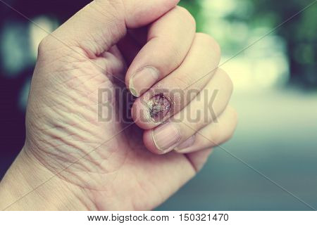 Fungal Nail Infection And Damage On Human Hand. Finger With Onychomycosis