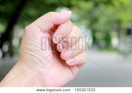 Fungal Nail Infection And Damage On Human Hand. Finger With Onychomycosis