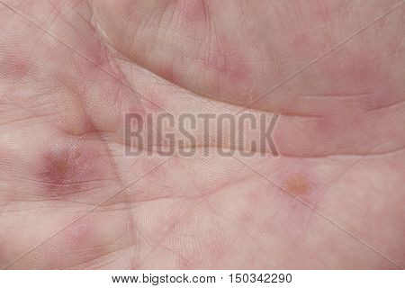 hand foot and mouth disease HFMD palm rash