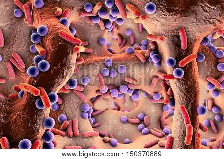 Spherical and rod-shaped bacteria inside bone tissue, on the surface of skin or mucous membrane. Osteomyelitis, 3D illustration