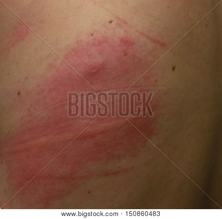 Rash On Sensitive Skin Or Skin Problem With Allergy Rash