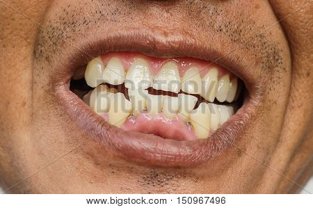 Closeup of an Asian man's Crooked teeth