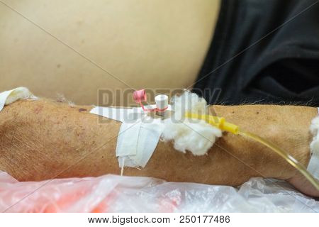 The Hand Of An Elderly Person With A Catheter In A Vein For Permanent Administration Of A Medicine I