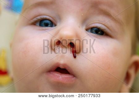 Close Up Image Of The Runny, Bloody Nose Of A Baby Boy Two Days After His Four Month Vaccines.  Adve