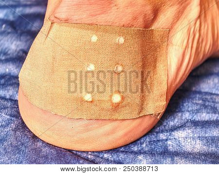 Leg Of Sports Man With Blister Or Burn Wound On Blue Hospital Background. Treatment Of Hurt Place.