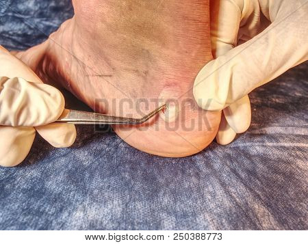 Nurse Help To Patient With Abrasion On The Skin On The Heel, Devastated Skin From Running Sports Sho