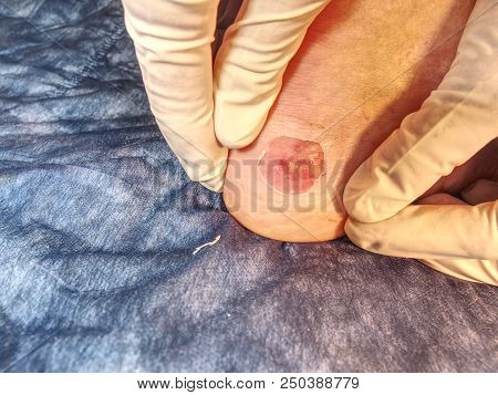 Small Surgery On Hurt Leg, Treatment Of The Wetting Wound. Untouchable Hot Heel With Burned Skin.