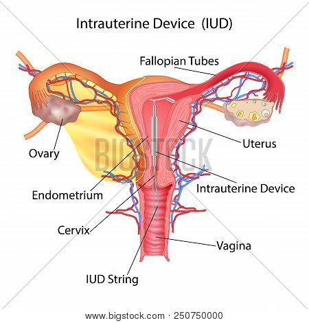 Contraception Method- Intrauterine Spiral From Pregnancy Vektor