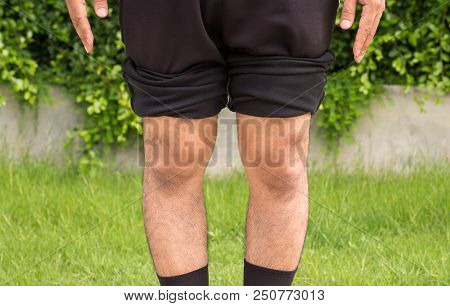 Asian Man Bandy-legged Shape Of The Physiological Bow Leg