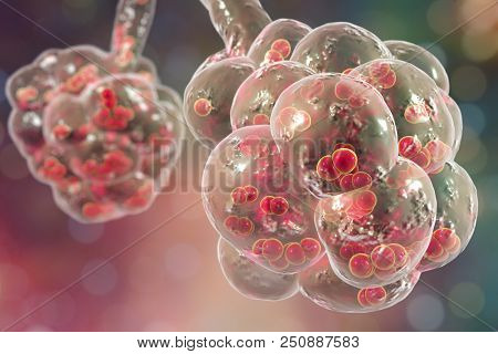 Pneumococcal Pneumonia, Medical Concept. 3d Illustration Showing Bacteria Streptococcus Pneumoniae I