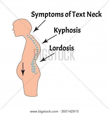 The Position Of The Spine With Lordosis, Kyphosis. Text Neck Syndrome. Spinal Curvature, Kyphosis, L