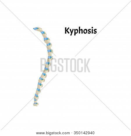 The Position Of The Spine With Kyphosis. Spinal Curvature, Kyphosis, Lordosis, Scoliosis, Arthrosis.