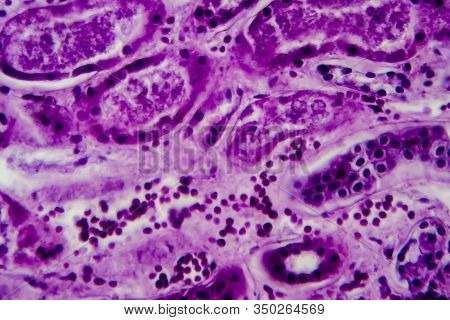 Diffuse Proliferative Glomerulonephritis, Light Micrograph, Photo Under Microscope. High Magnificati