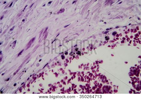 Acute Glomerulonephritis, Light Micrograph, Photo Under Microscope