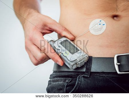 Diabetic Man With An Insulin Pump Connected In His Abdomen