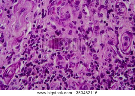 Chronic Glomerulonephritis, Light Micrograph, Photo Under Microscope. High Magnification