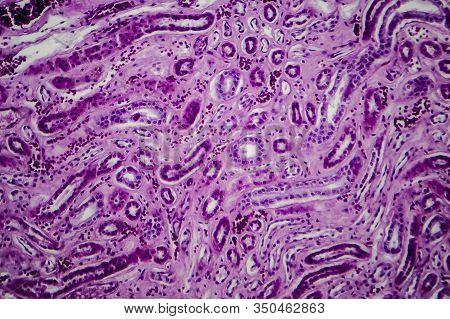 Diffuse Proliferative Glomerulonephritis, Dpgn, Light Micrograph, Photo Under Microscope