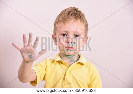 Young Toddler,boy With Chickenpox. Sick Child With Chickenpox. Varicella Virus Or Chickenpox Bubble