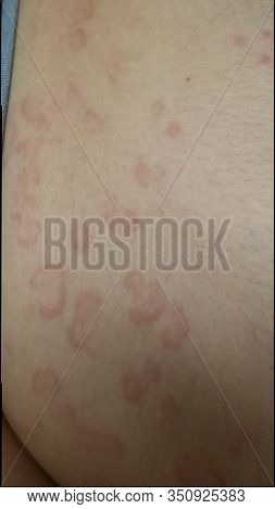 Erythema Multiforme Annular Erythematous Targetoid Skin Lesions