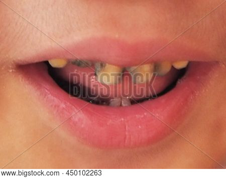 Close-up Photo Of Unmaintained Baby Teeth, Asian
