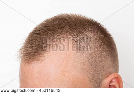 Bald Patches On The Head Of A Young Man. The Concept Of The Increased Hormone Dihydrotestosterone. W